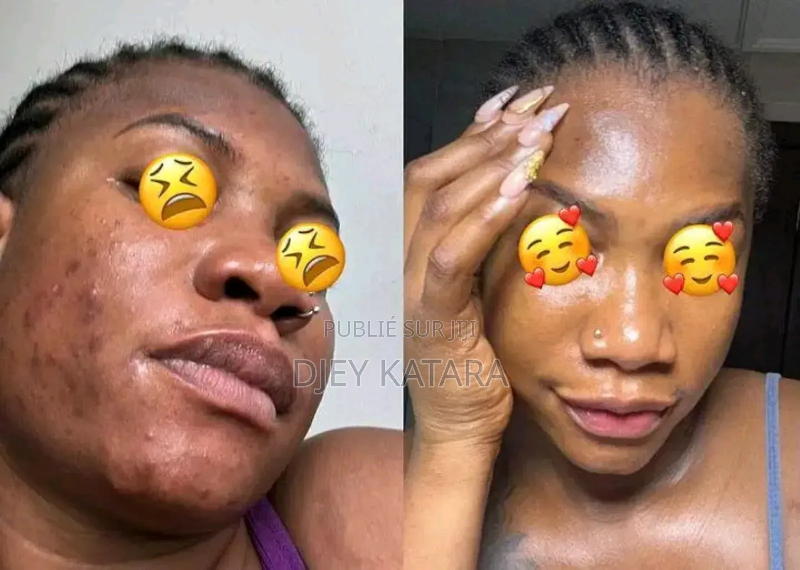 Kit Anti Acné Et Tâches