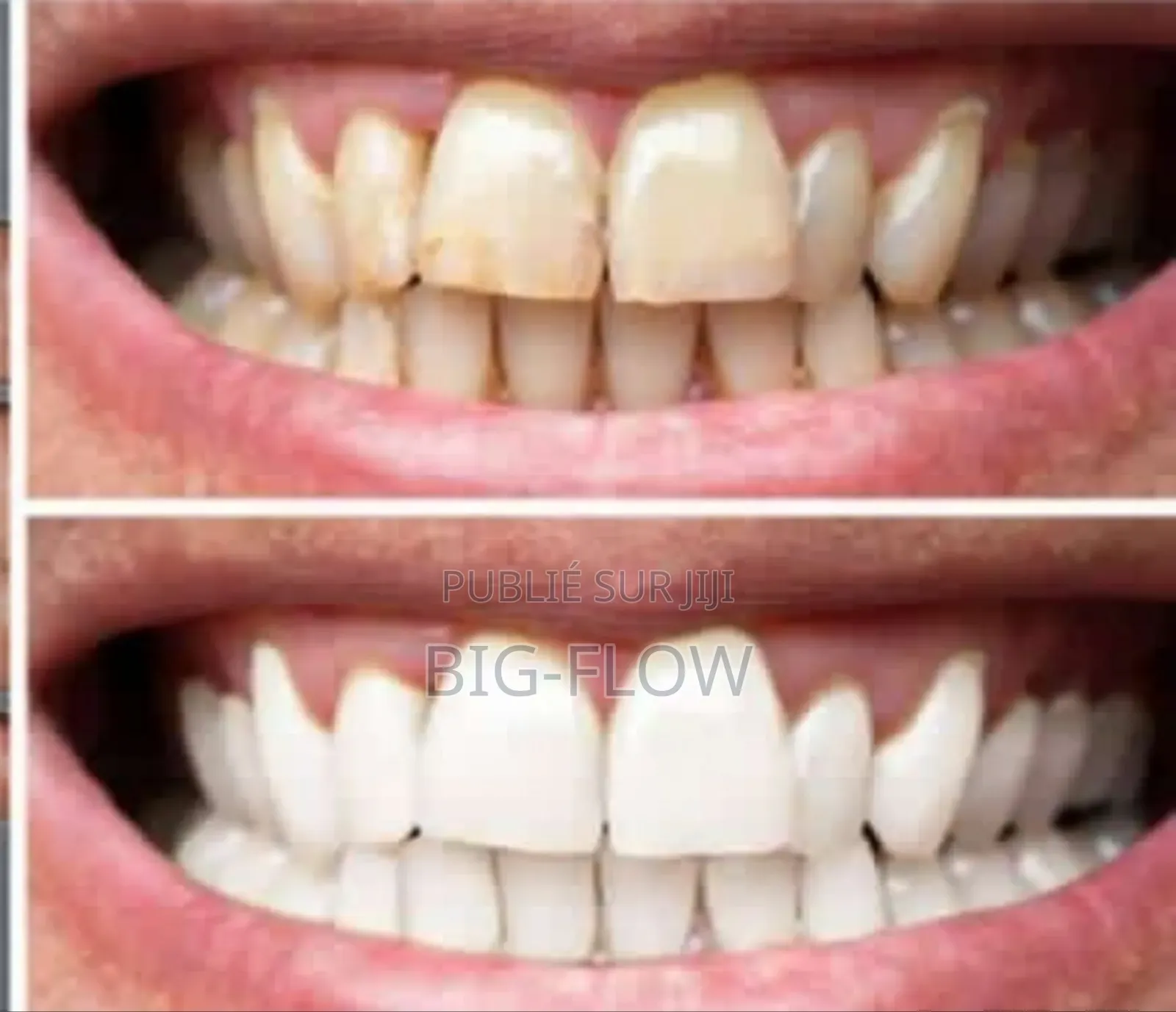 Blanchiment Des Dents