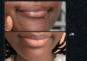 Stop Lèvres Noires Produit Lèvre Rose Résultat en 3jours