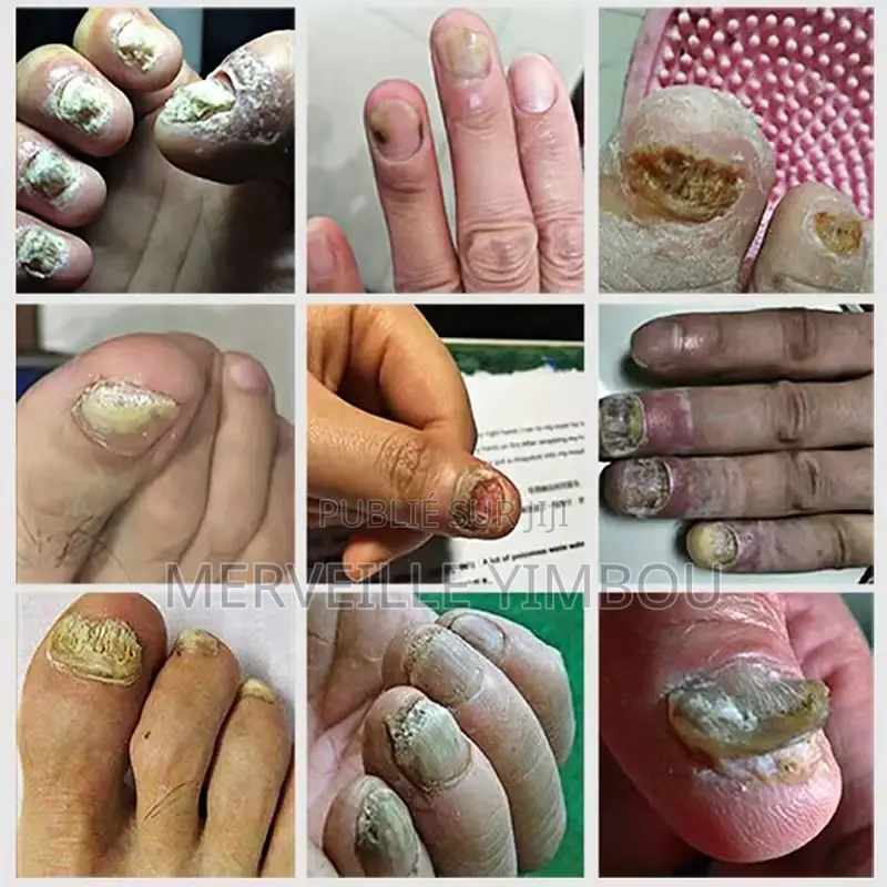 Traitement Ongle