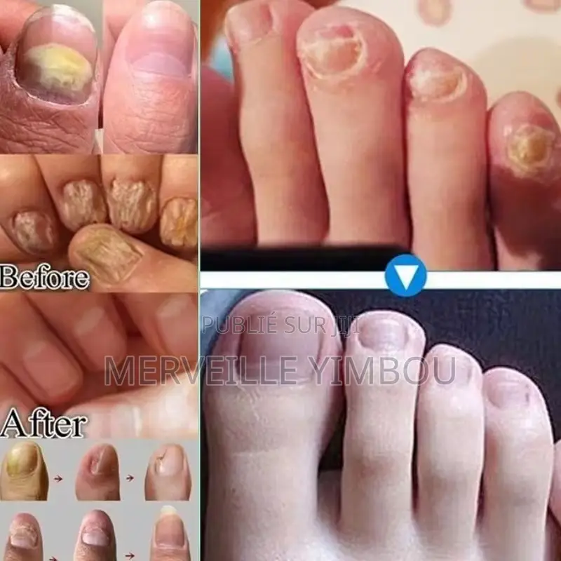 Traitement Ongle